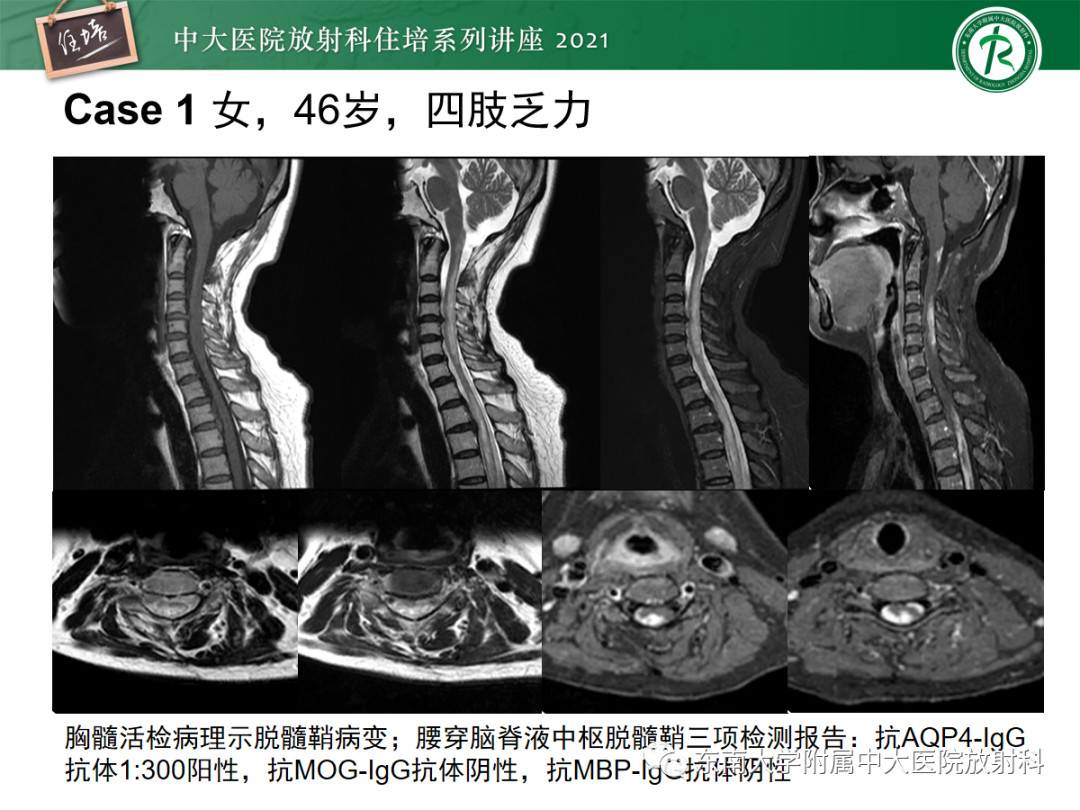 影像PPT - 【PPT】视神经脊髓炎谱系疾病影像表现及鉴别诊断-28