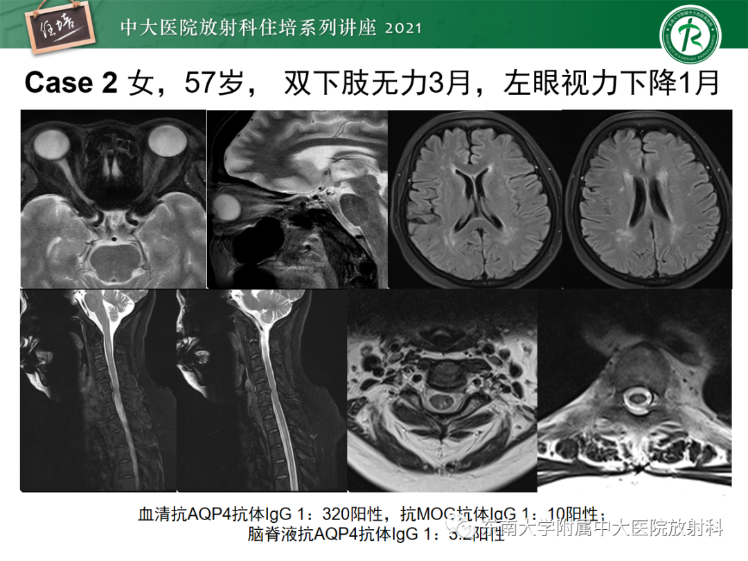 影像PPT - 【PPT】视神经脊髓炎谱系疾病影像表现及鉴别诊断-29