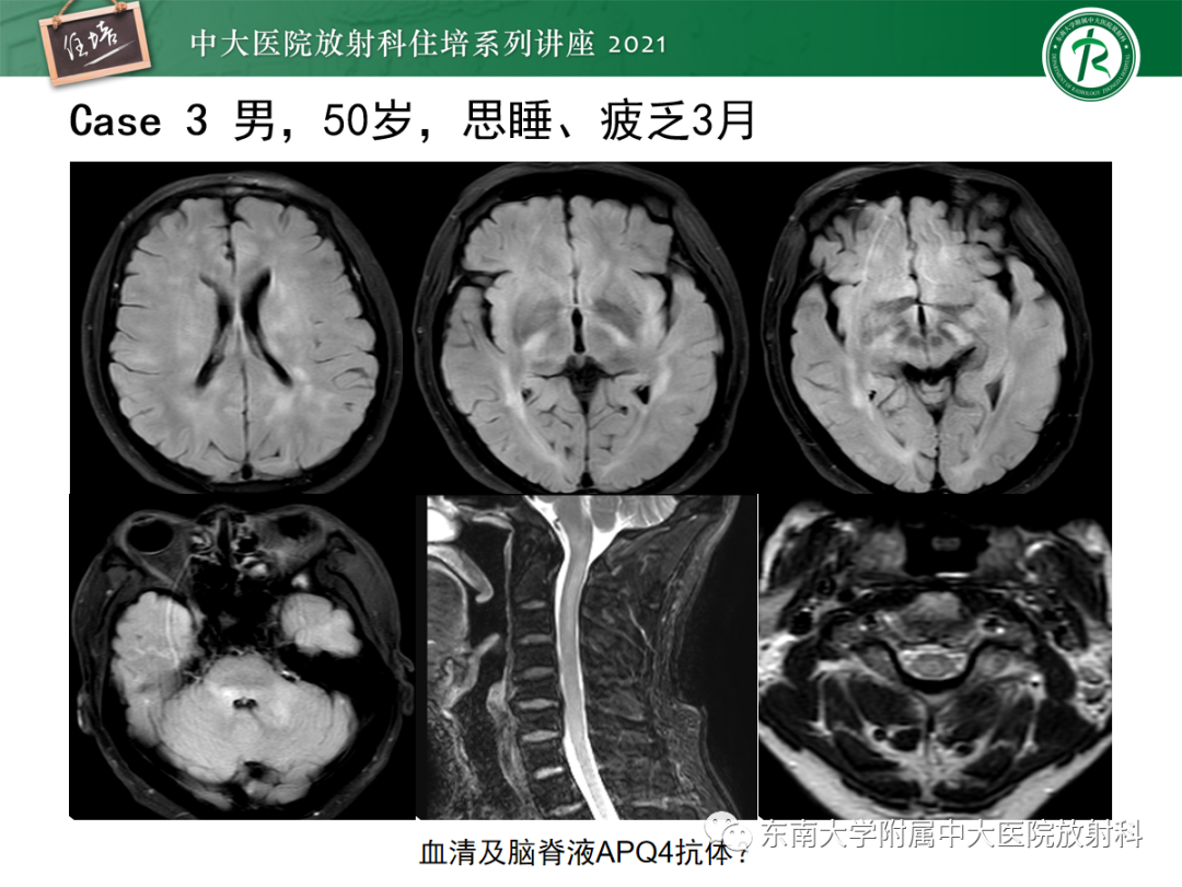 影像PPT - 【PPT】视神经脊髓炎谱系疾病影像表现及鉴别诊断-30