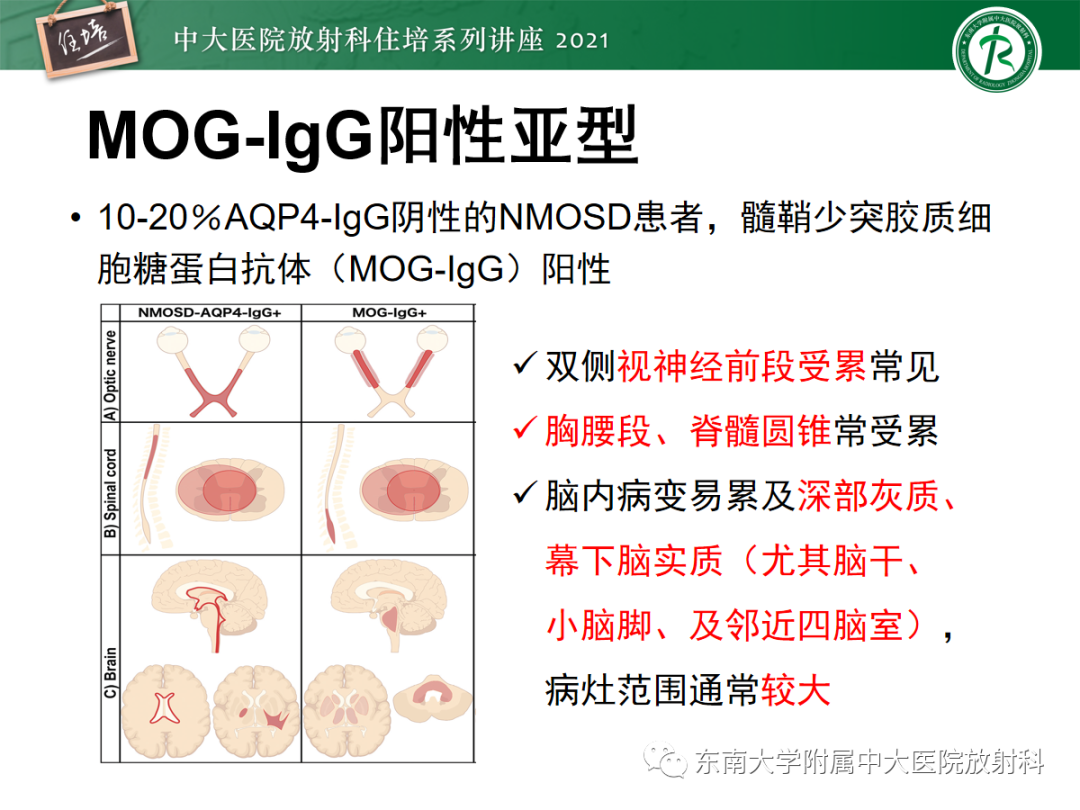 影像PPT - 【PPT】视神经脊髓炎谱系疾病影像表现及鉴别诊断-31
