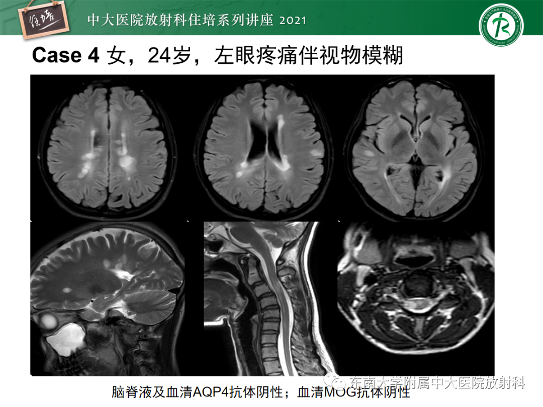 影像PPT - 【PPT】视神经脊髓炎谱系疾病影像表现及鉴别诊断-33