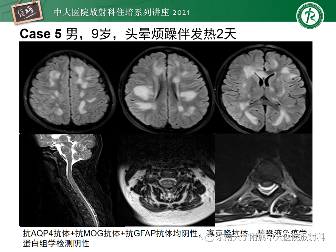 影像PPT - 【PPT】视神经脊髓炎谱系疾病影像表现及鉴别诊断-35