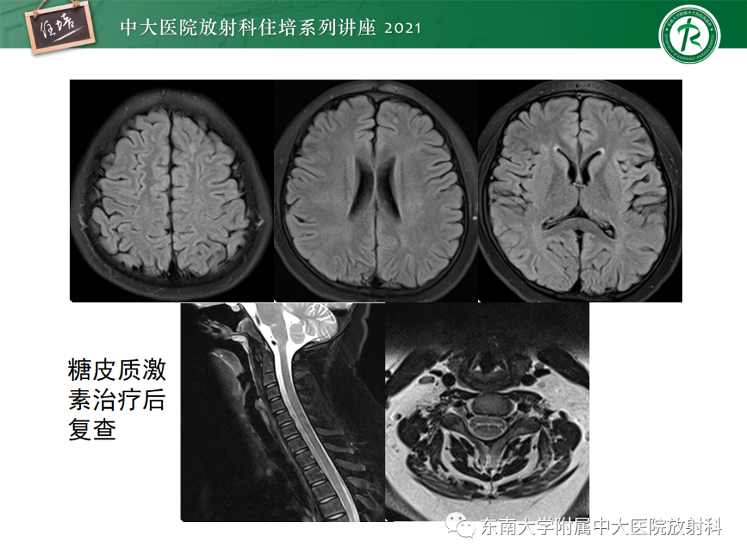 影像PPT - 【PPT】视神经脊髓炎谱系疾病影像表现及鉴别诊断-36