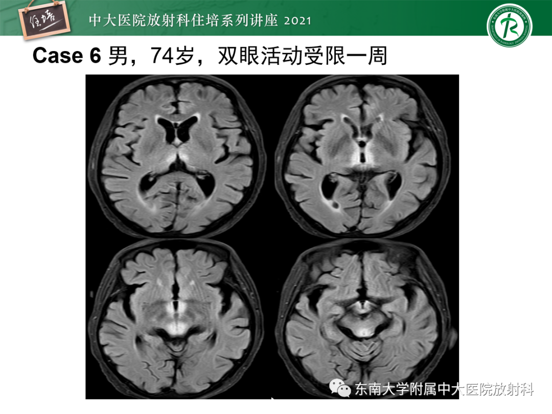 影像PPT - 【PPT】视神经脊髓炎谱系疾病影像表现及鉴别诊断-38
