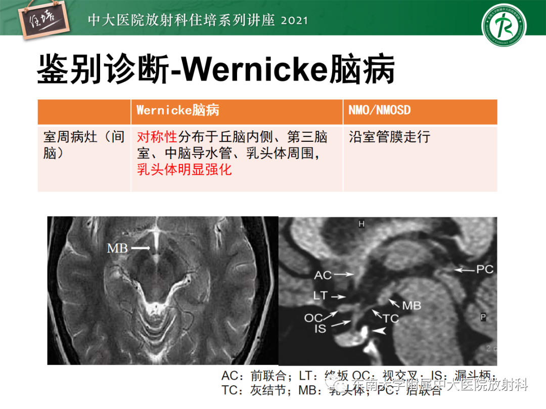 影像PPT - 【PPT】视神经脊髓炎谱系疾病影像表现及鉴别诊断-39