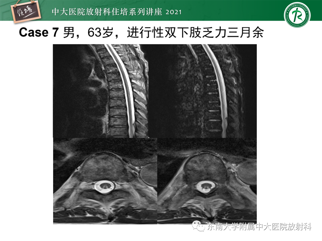 影像PPT - 【PPT】视神经脊髓炎谱系疾病影像表现及鉴别诊断-40