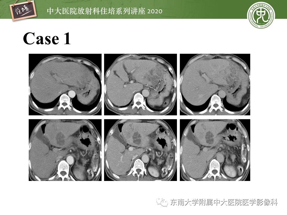影像PPT - 【PPT】肝脏感染性病变的诊断及鉴别-2