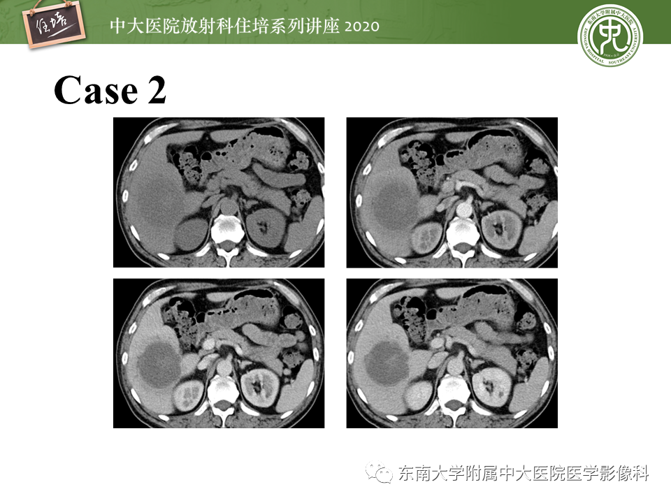 影像PPT - 【PPT】肝脏感染性病变的诊断及鉴别-3