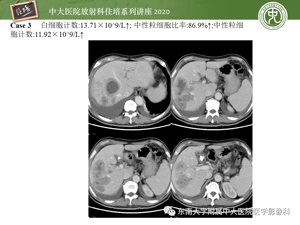 影像PPT - 【PPT】肝脏感染性病变的诊断及鉴别-13