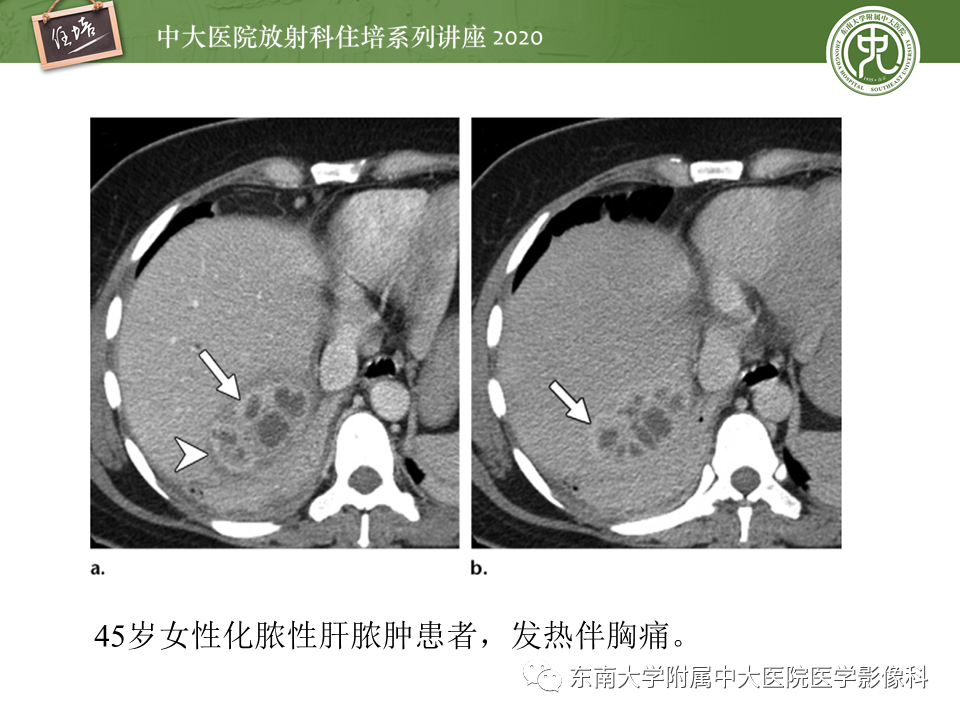 影像PPT - 【PPT】肝脏感染性病变的诊断及鉴别-14