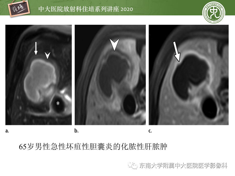 影像PPT - 【PPT】肝脏感染性病变的诊断及鉴别-15