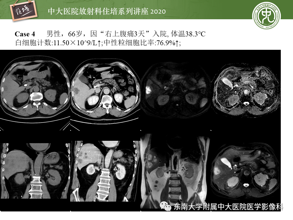 影像PPT - 【PPT】肝脏感染性病变的诊断及鉴别-16