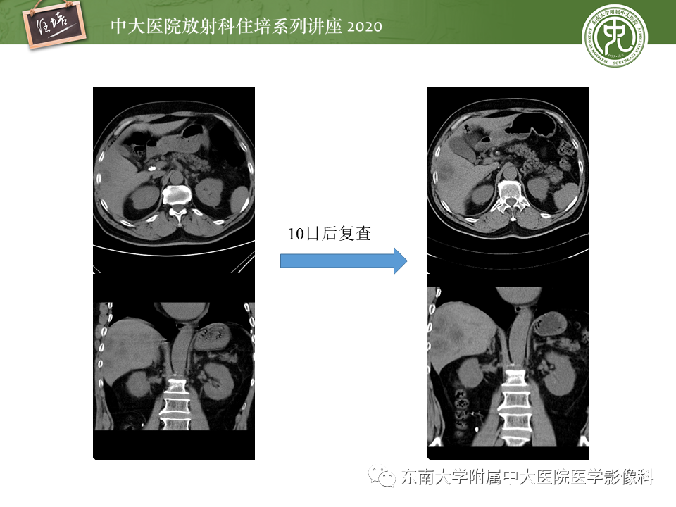 影像PPT - 【PPT】肝脏感染性病变的诊断及鉴别-17