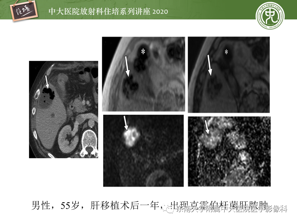 影像PPT - 【PPT】肝脏感染性病变的诊断及鉴别-19