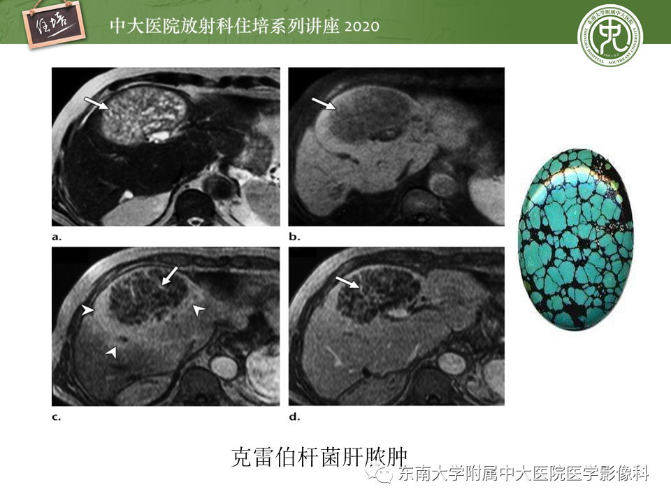影像PPT - 【PPT】肝脏感染性病变的诊断及鉴别-20