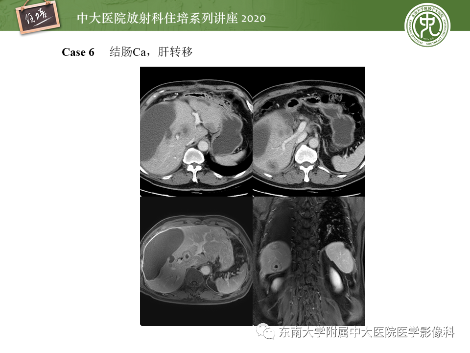 影像PPT - 【PPT】肝脏感染性病变的诊断及鉴别-24