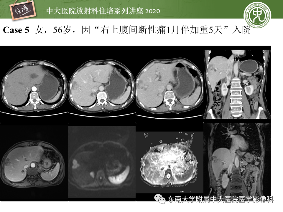 影像PPT - 【PPT】肝脏感染性病变的诊断及鉴别-22