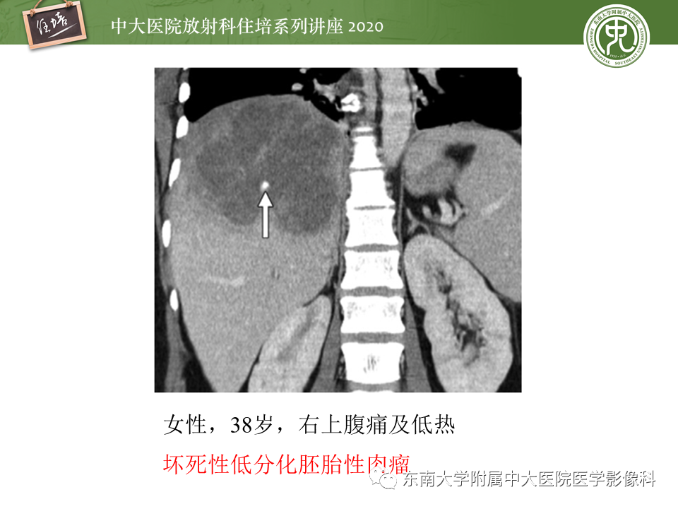 影像PPT - 【PPT】肝脏感染性病变的诊断及鉴别-25