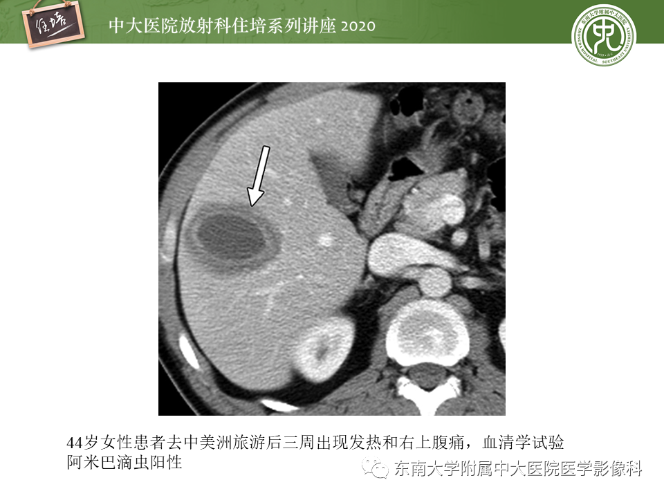 影像PPT - 【PPT】肝脏感染性病变的诊断及鉴别-29