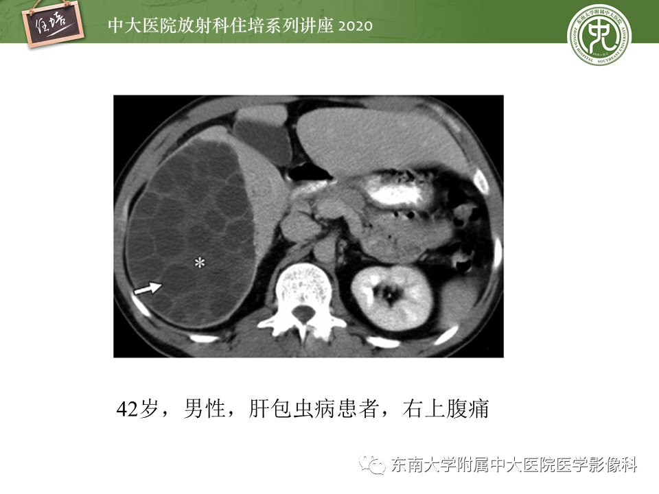 影像PPT - 【PPT】肝脏感染性病变的诊断及鉴别-32