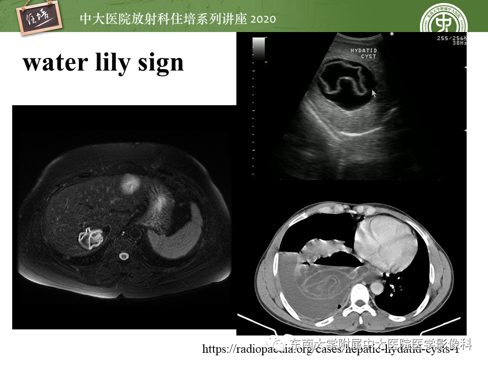 影像PPT - 【PPT】肝脏感染性病变的诊断及鉴别-33