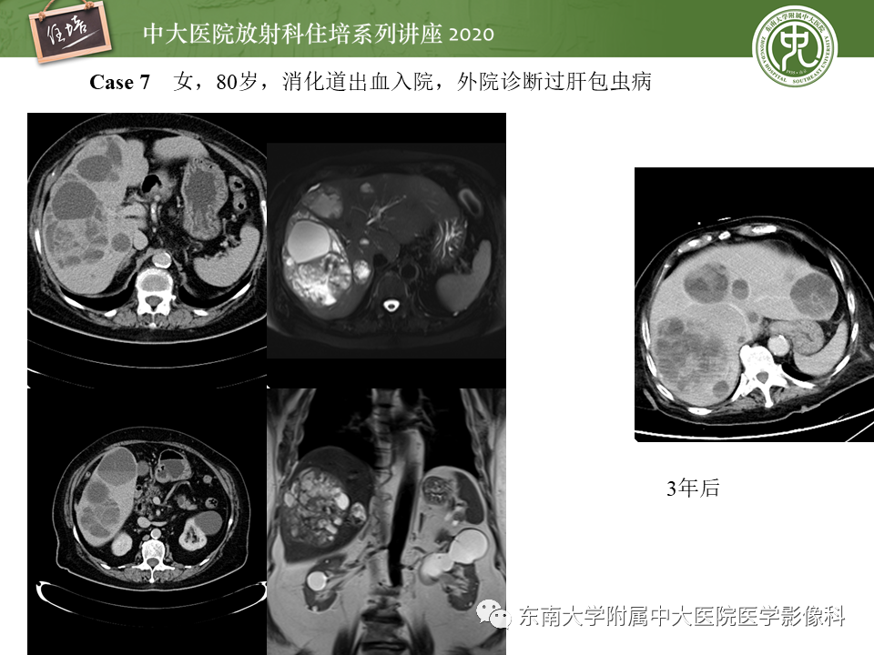 影像PPT - 【PPT】肝脏感染性病变的诊断及鉴别-36