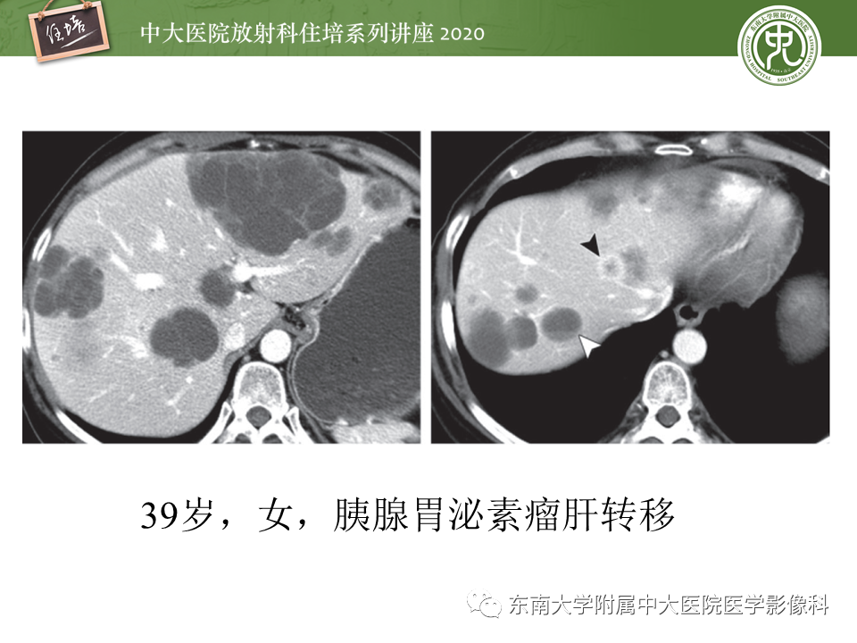 影像PPT - 【PPT】肝脏感染性病变的诊断及鉴别-39