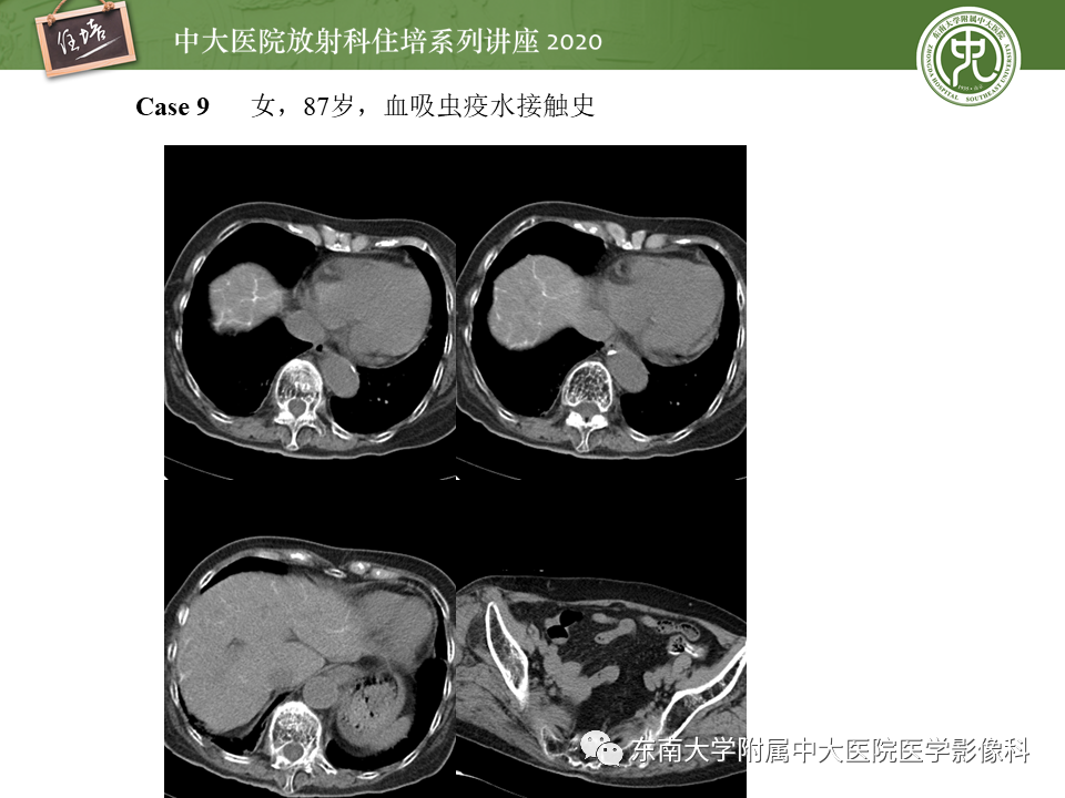 影像PPT - 【PPT】肝脏感染性病变的诊断及鉴别-43