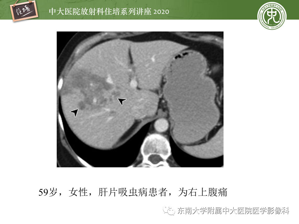 影像PPT - 【PPT】肝脏感染性病变的诊断及鉴别-48