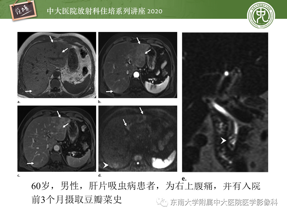 影像PPT - 【PPT】肝脏感染性病变的诊断及鉴别-50