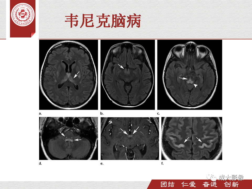 影像PPT - 【PPT】毒性和代谢性脑疾病的影像-15