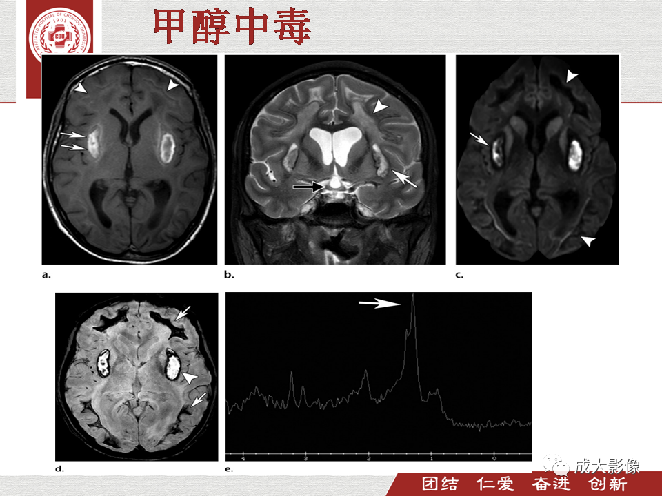 影像PPT - 【PPT】毒性和代谢性脑疾病的影像-16