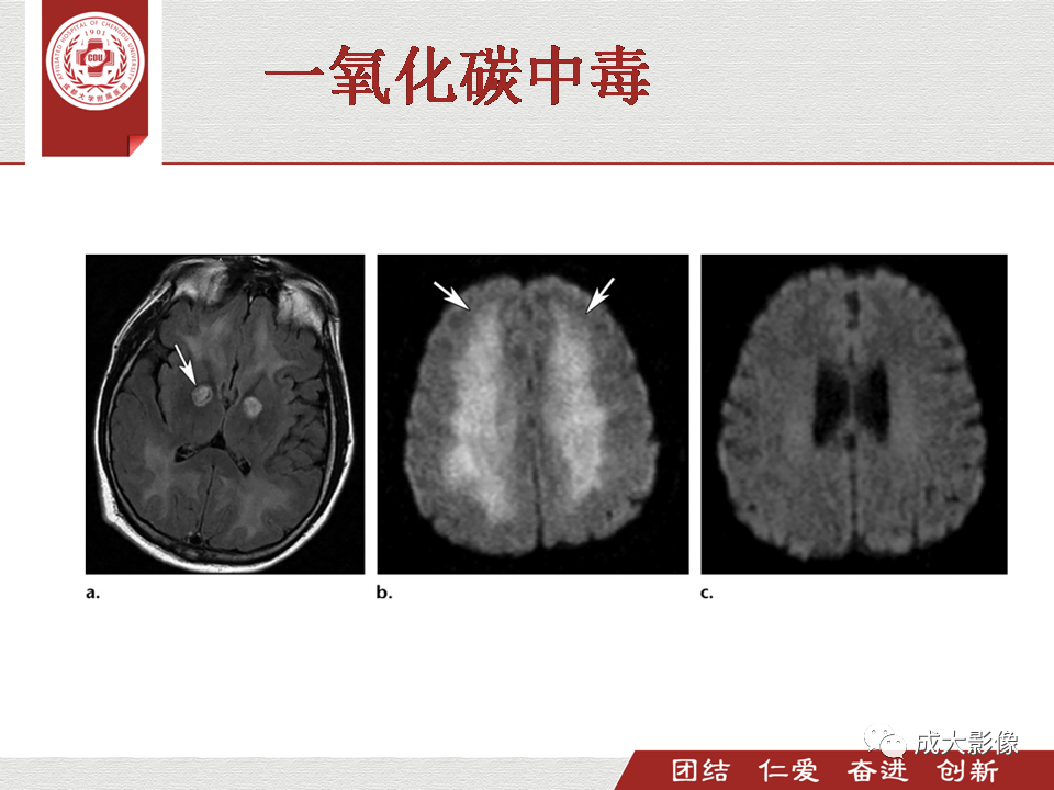 影像PPT - 【PPT】毒性和代谢性脑疾病的影像-17