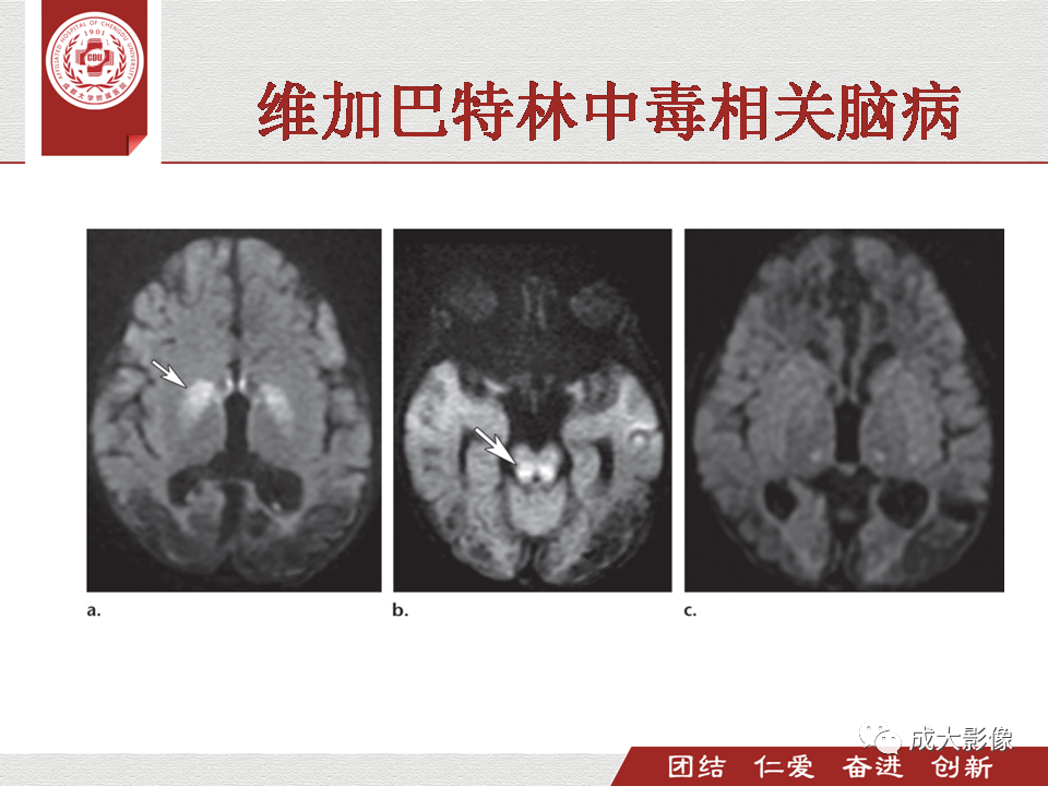 影像PPT - 【PPT】毒性和代谢性脑疾病的影像-18