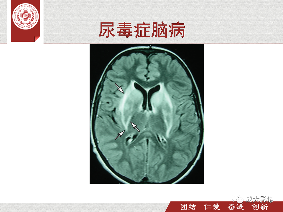 影像PPT - 【PPT】毒性和代谢性脑疾病的影像-19