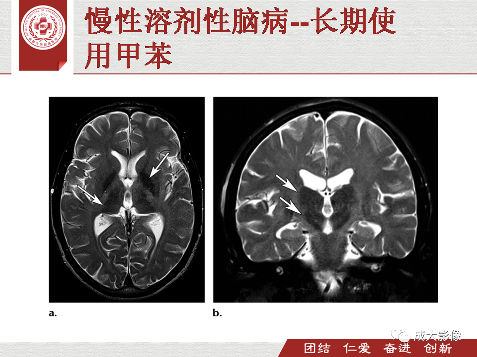 影像PPT - 【PPT】毒性和代谢性脑疾病的影像-21