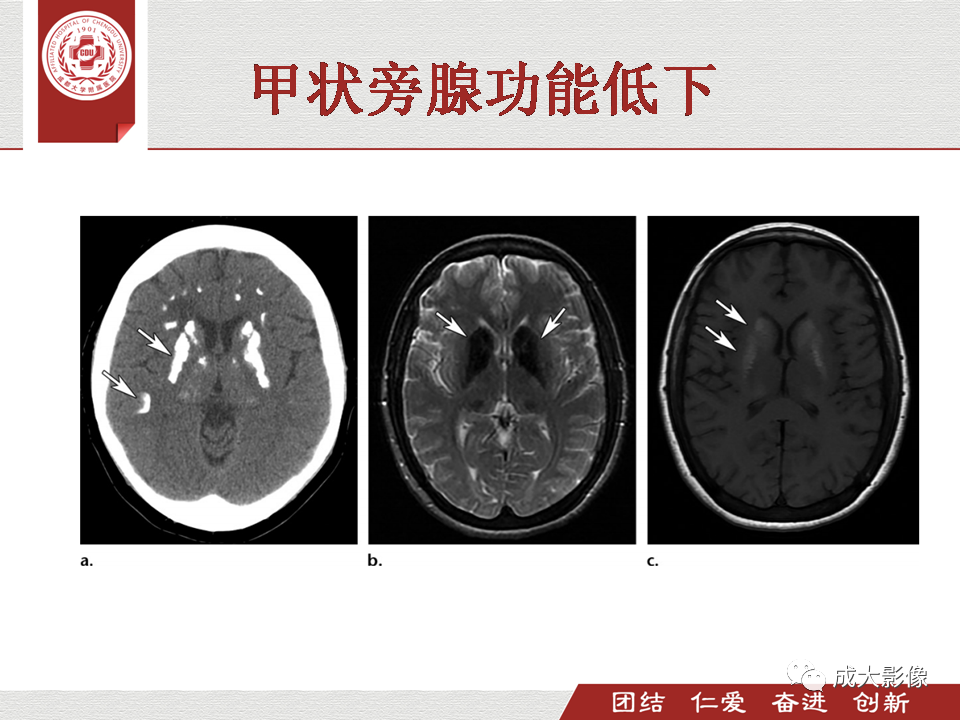 影像PPT - 【PPT】毒性和代谢性脑疾病的影像-22