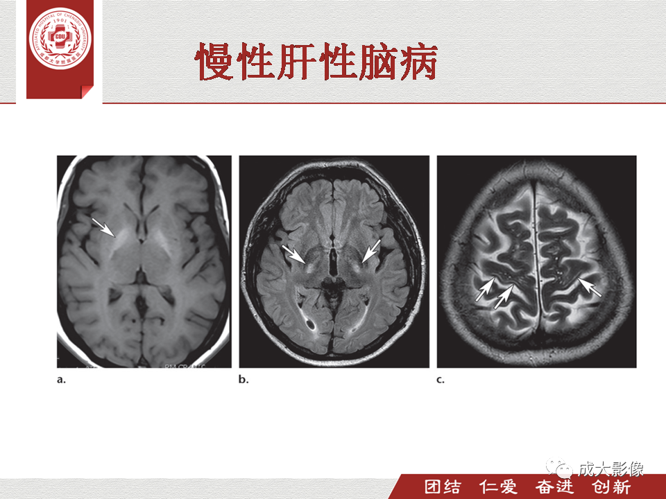 影像PPT - 【PPT】毒性和代谢性脑疾病的影像-25