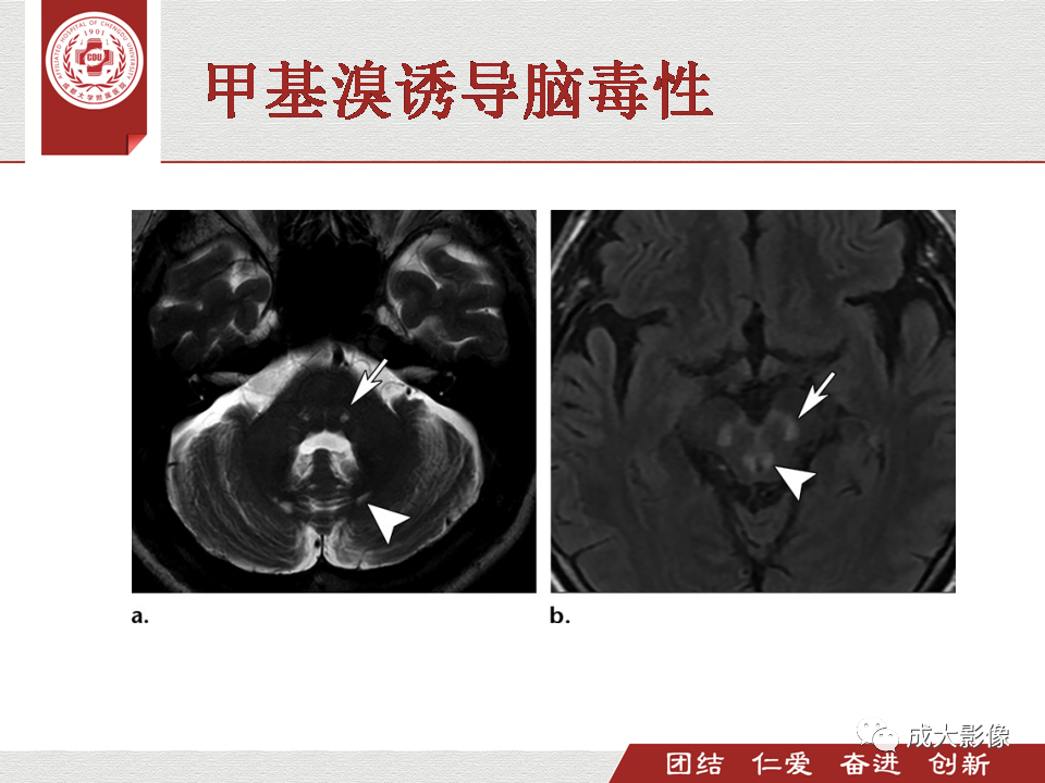 影像PPT - 【PPT】毒性和代谢性脑疾病的影像-28