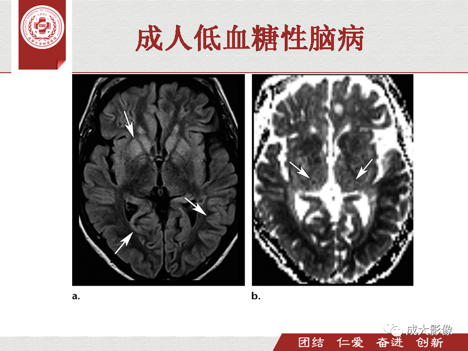 影像PPT - 【PPT】毒性和代谢性脑疾病的影像-30
