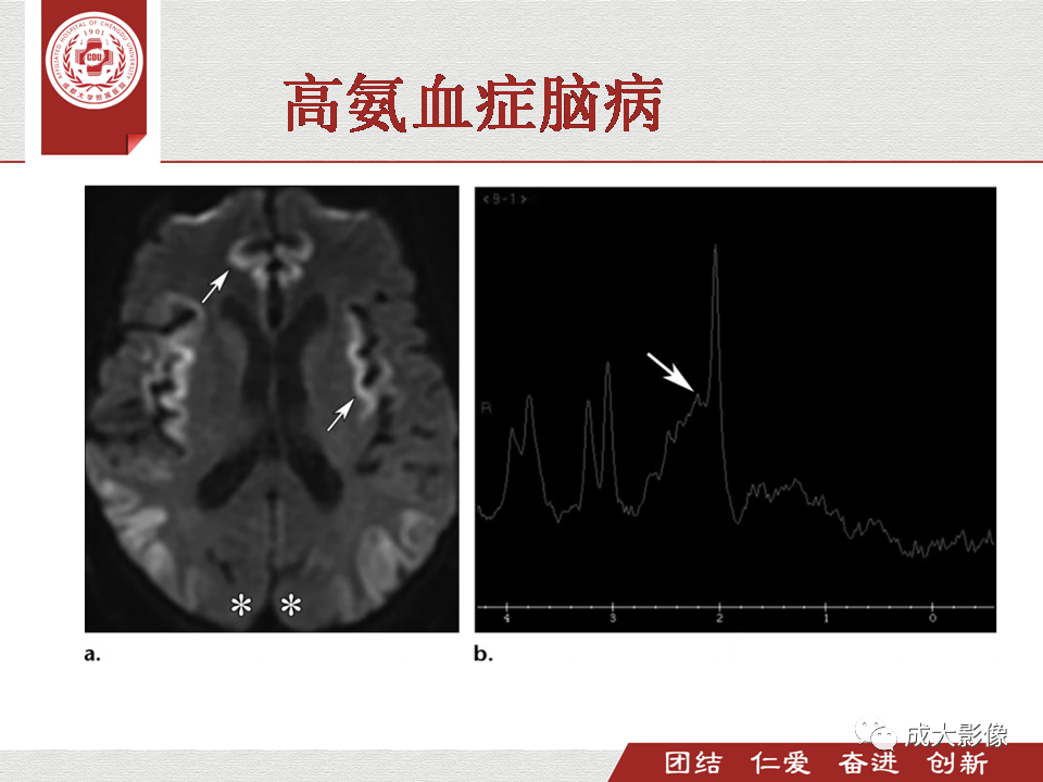 影像PPT - 【PPT】毒性和代谢性脑疾病的影像-31