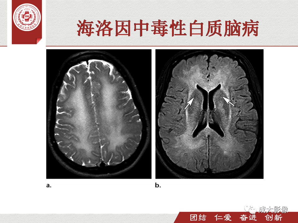 影像PPT - 【PPT】毒性和代谢性脑疾病的影像-33