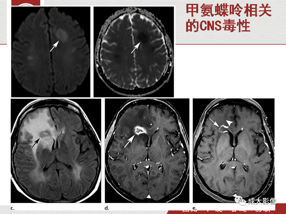 影像PPT - 【PPT】毒性和代谢性脑疾病的影像-34