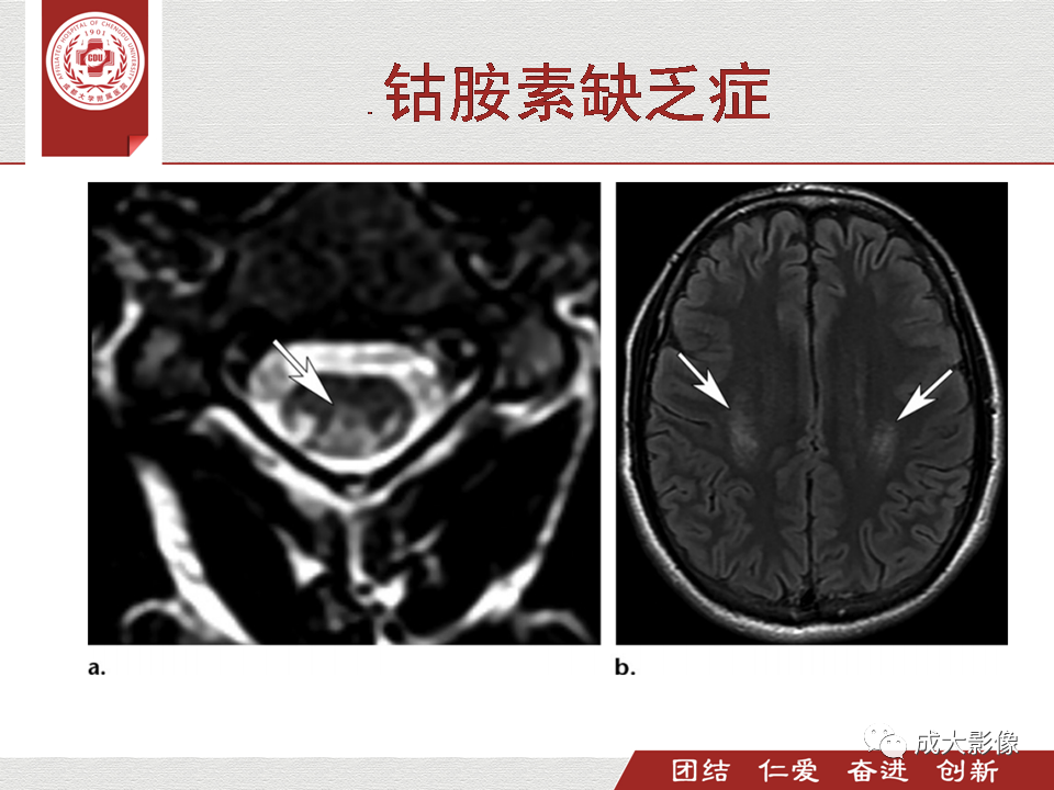 影像PPT - 【PPT】毒性和代谢性脑疾病的影像-37