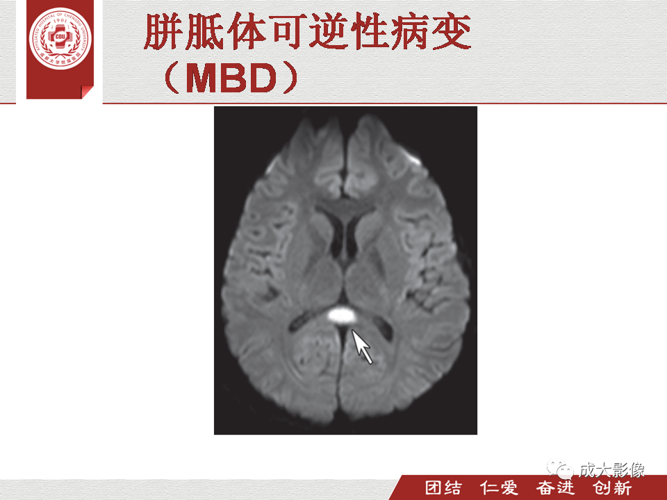 影像PPT - 【PPT】毒性和代谢性脑疾病的影像-40