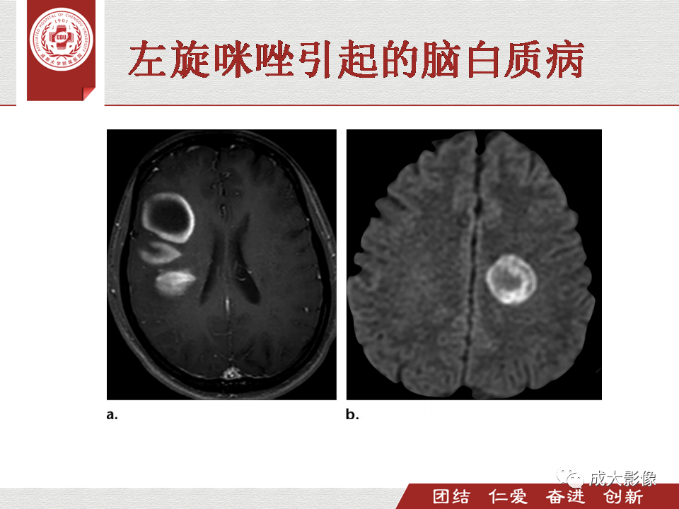 影像PPT - 【PPT】毒性和代谢性脑疾病的影像-42
