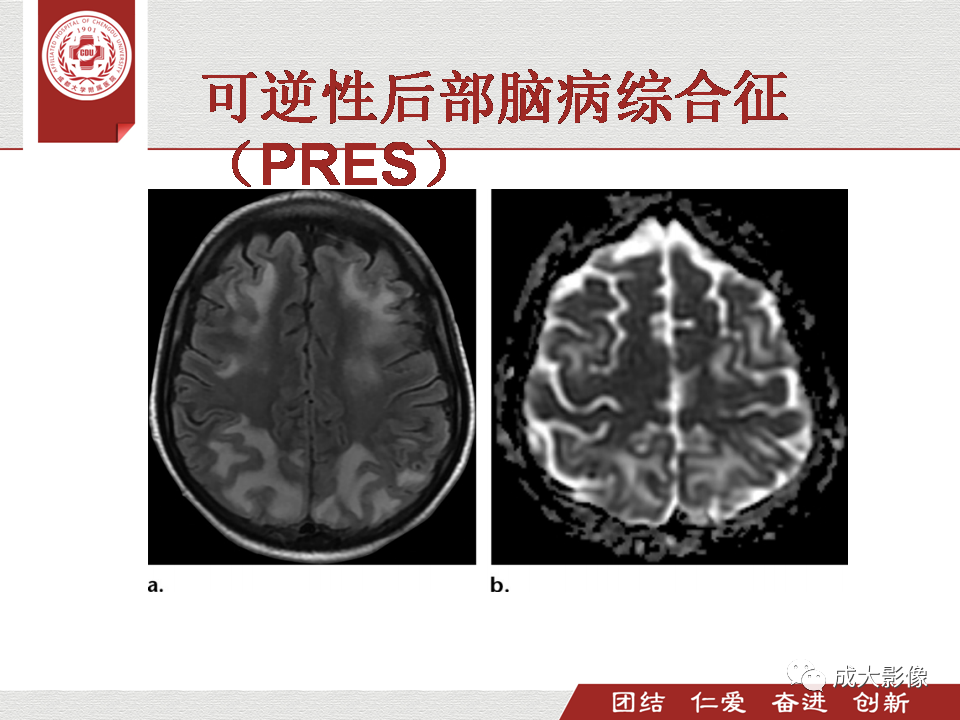 影像PPT - 【PPT】毒性和代谢性脑疾病的影像-44