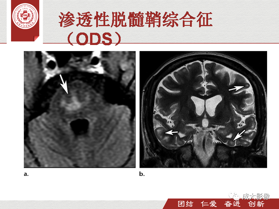 影像PPT - 【PPT】毒性和代谢性脑疾病的影像-46