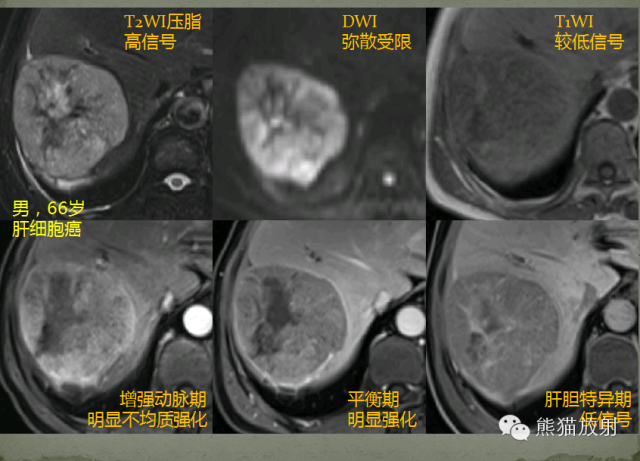 影像PPT - 肝脏T2高信号中心瘢痕病变的鉴别诊断-7
