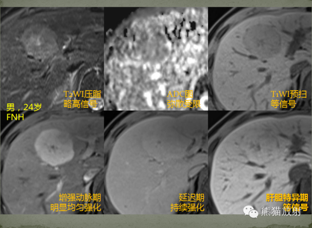 影像PPT - 肝脏T2高信号中心瘢痕病变的鉴别诊断-8
